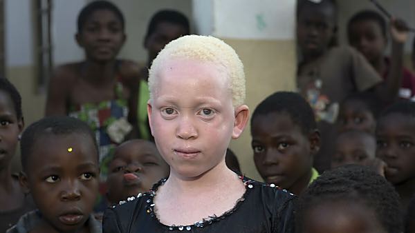 У темнокожей пары родилась девочка альбинос, прошло 10 лет