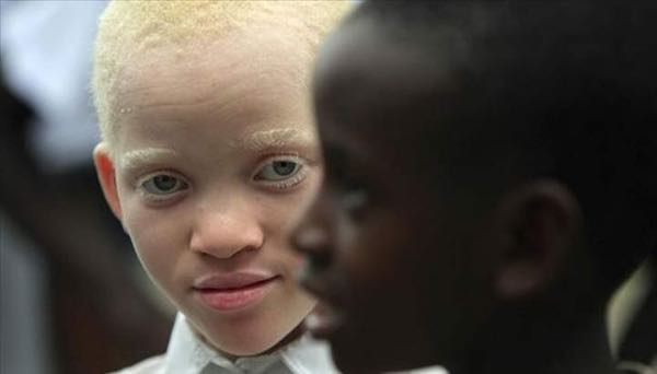 У темнокожей пары родилась девочка альбинос, прошло 10 лет